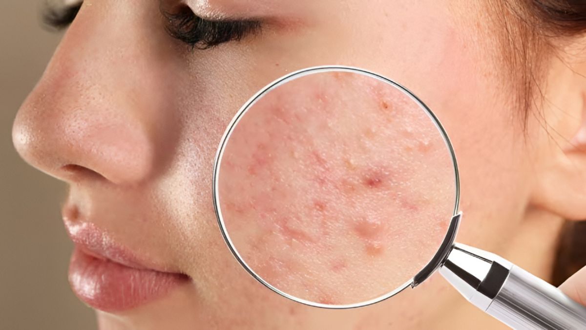 American Academy of Dermatology Reveals How Your Pillowcase Could Be Causing Acne